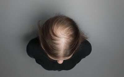 Alopecie – Physiotherapeutische und nicht-medikamentöse Ansätze