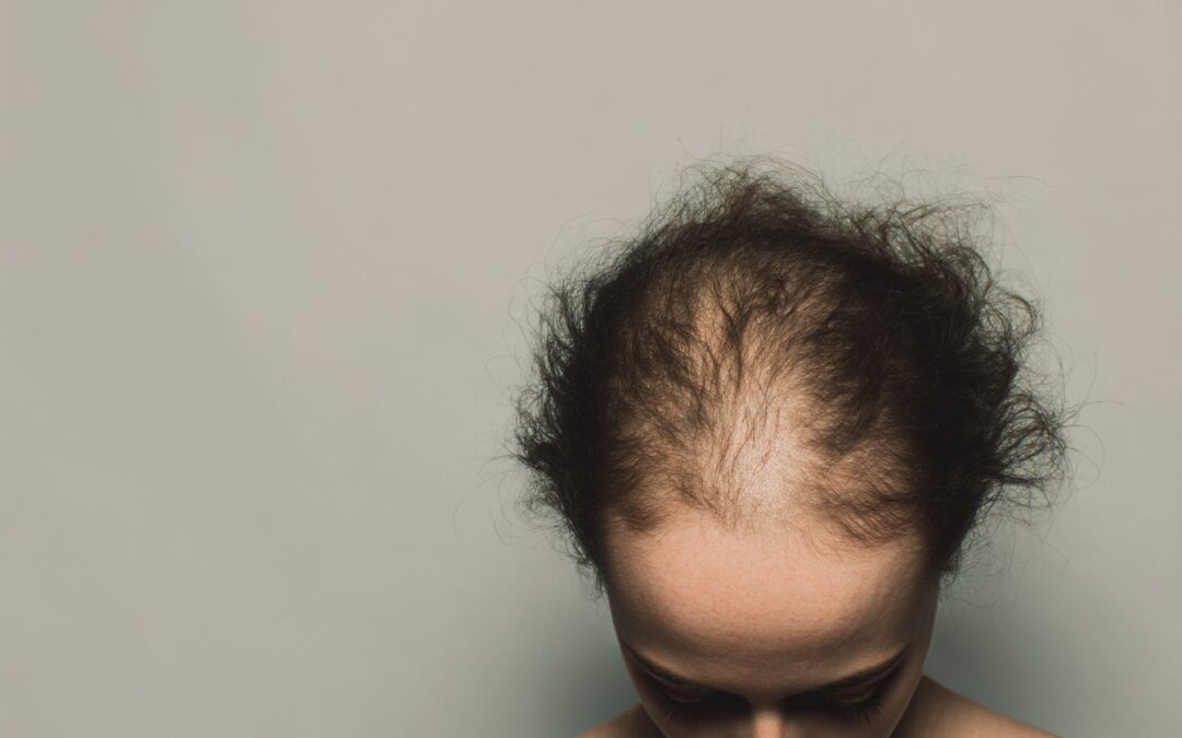 Alopecie – Behandlung mit medikamentösen Therapien