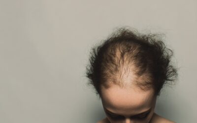 Alopecie – Behandlung mit medikamentösen Therapien