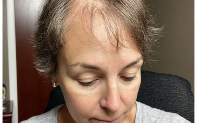 Alopecia areata: Ist Heilung möglich