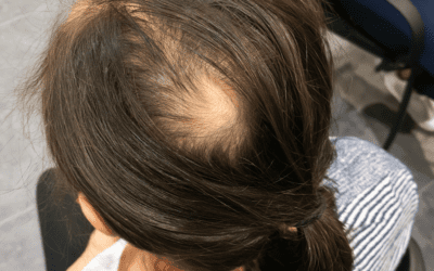 Globale Krankheitslast der Alopecia Areata